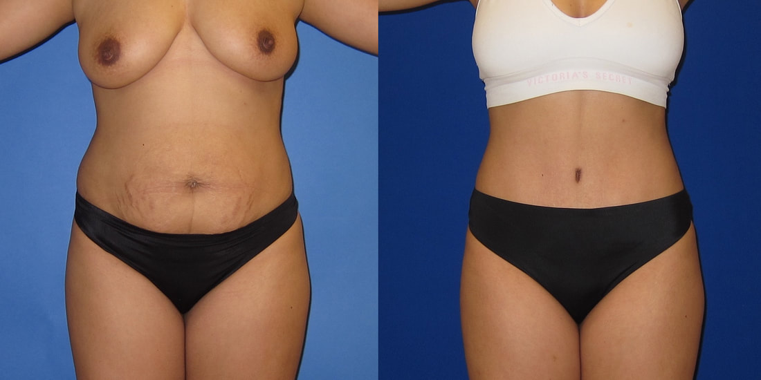 https://www.drhayescosmeticsurgery.com/uploads/6/9/2/9/69297503/before-and-after-full-tummy-tuck-with-lipo-c_orig.jpg