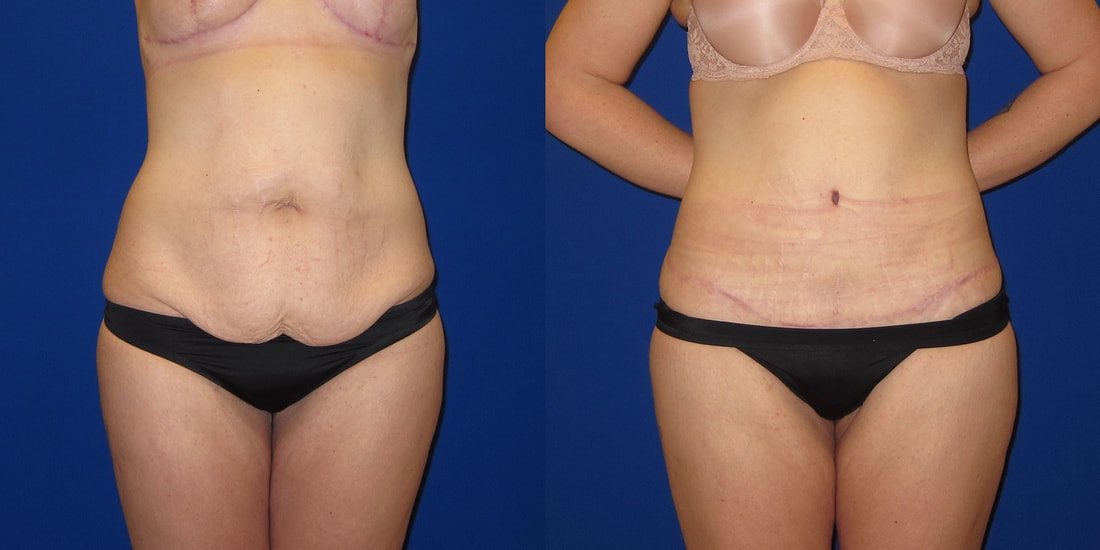 https://www.drhayescosmeticsurgery.com/uploads/6/9/2/9/69297503/before-and-after-photo-of-270-degree-tummy-tuck-with-liposuction-b_orig.jpg