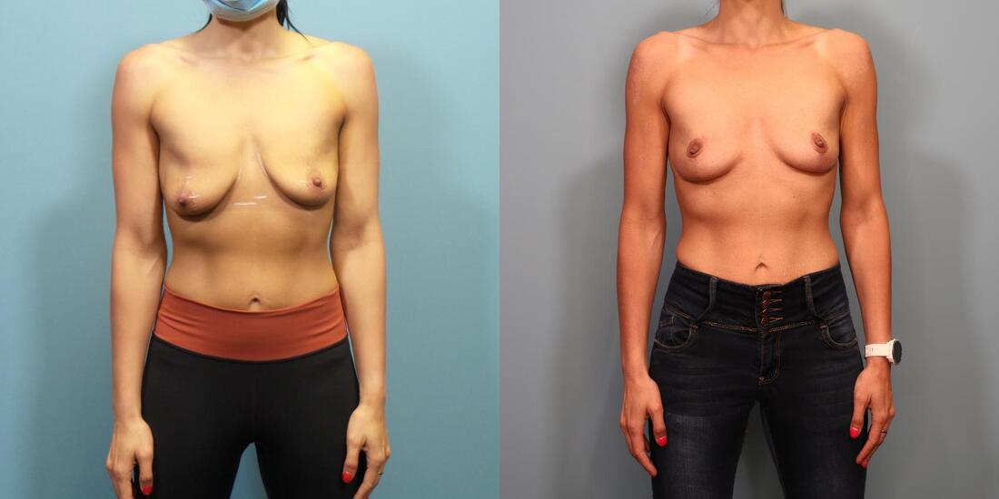 Breast Lift Before and After Photos - Portland Plastic Surgery