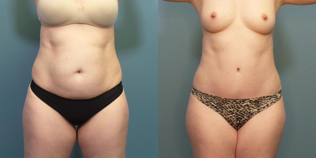 https://www.drhayescosmeticsurgery.com/uploads/6/9/2/9/69297503/photo-of-a-woman-before-and-after-tummy-tuck-surgery-c_orig.jpeg